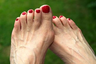 Bunion Correction with Scarf and Akin Osteotomy Bunion Correction with Scarf and Akin Osteotomy