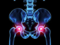 Hip Labral Tear Hip Labral Tear