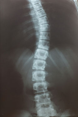 Early Onset Scoliosis