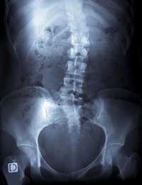 Adult Scoliosis Diagnosis & Treatment - San Antonio, TX Spine Doctor